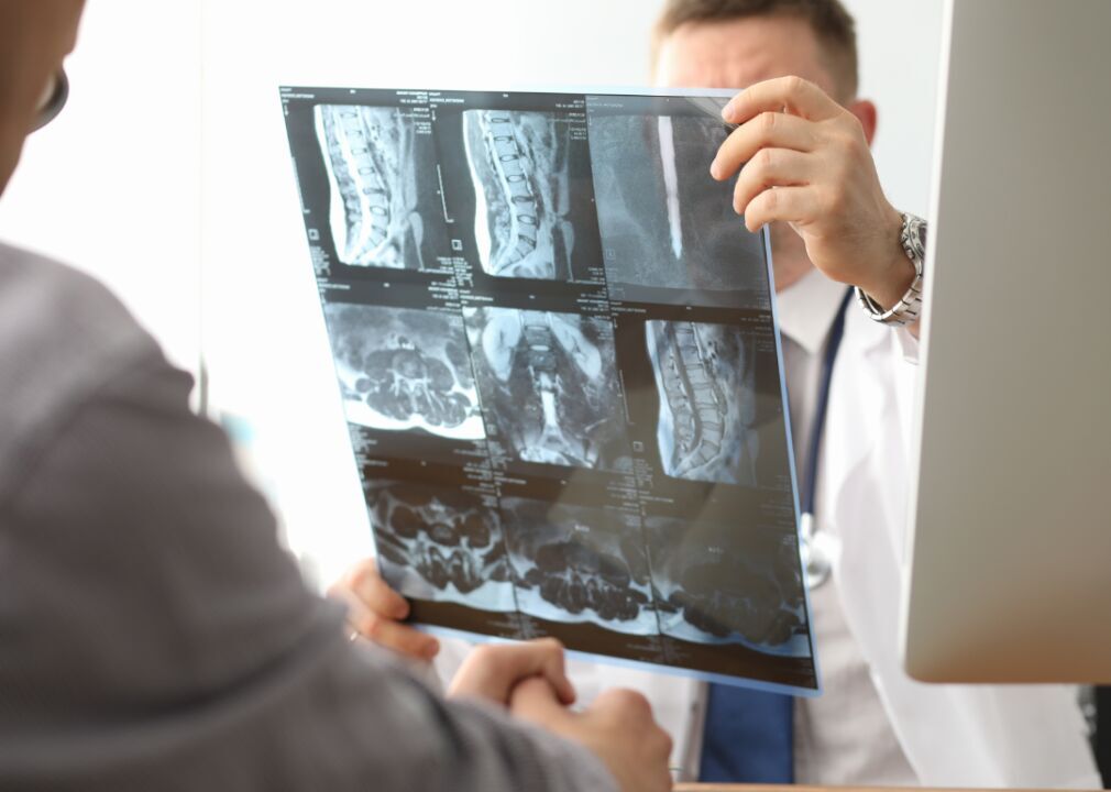 Bone loss restoration